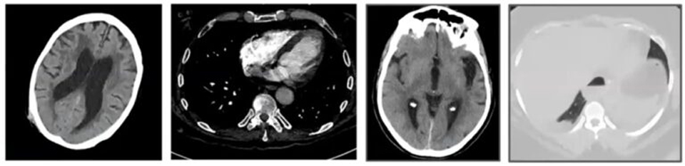 AI helps Radiologist find subtle findings