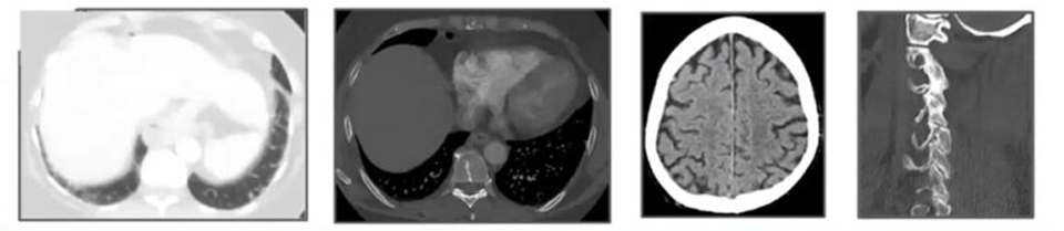 AI helps Radiologist find subtle findings